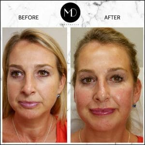 Facial Rebalancing - Joanna Lips & Cheeks-1000