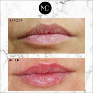 Lip Reshaping - Gemma Lips Seperate-1000