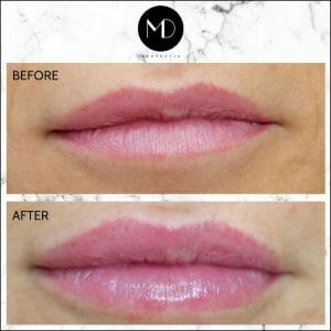 Lip Reshaping - Jemma Lips-1000