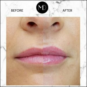 Lip Reshaping - Jemma Lips Side by Side-1000