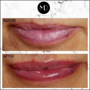 Lip Reshaping - Joanna Lips-1000