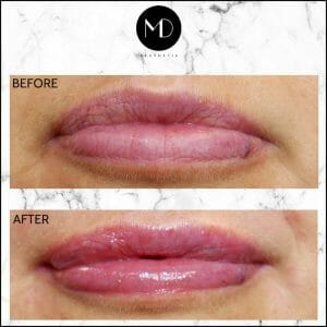 Lip Reshaping - Joanna Second Lips-1000