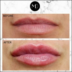 Lip Reshaping - Louise Lips Seperate-1000