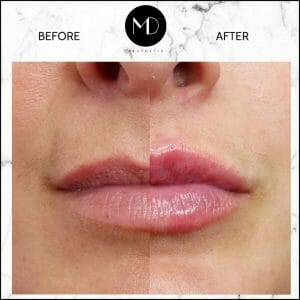 Lip Reshaping - Louise Lips Side by Side-1000