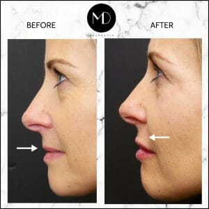 Lip Reshaping - Paula Side View-1000