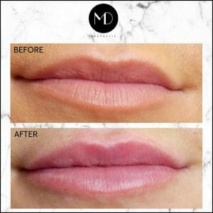 Lip Reshaping - Rachel Lips-1000