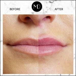 Lip Reshaping - Rachel Lips Side by Side-1000