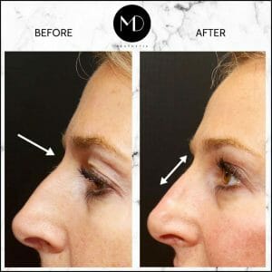 Nose reshaping - Joanna Nose-1000