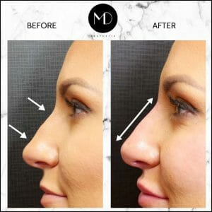 Nose reshaping - Rachel Side Nose-1000