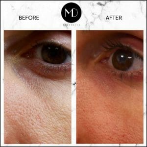 Under Eye Rejuvenation - Marco Close Up-1000