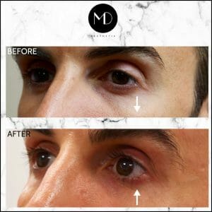 Under Eye Rejuvenation - Marco Tear Trough-1000