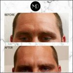 Wrinkle-Relaxing- Treatment-Leigh-Before-After-300x300